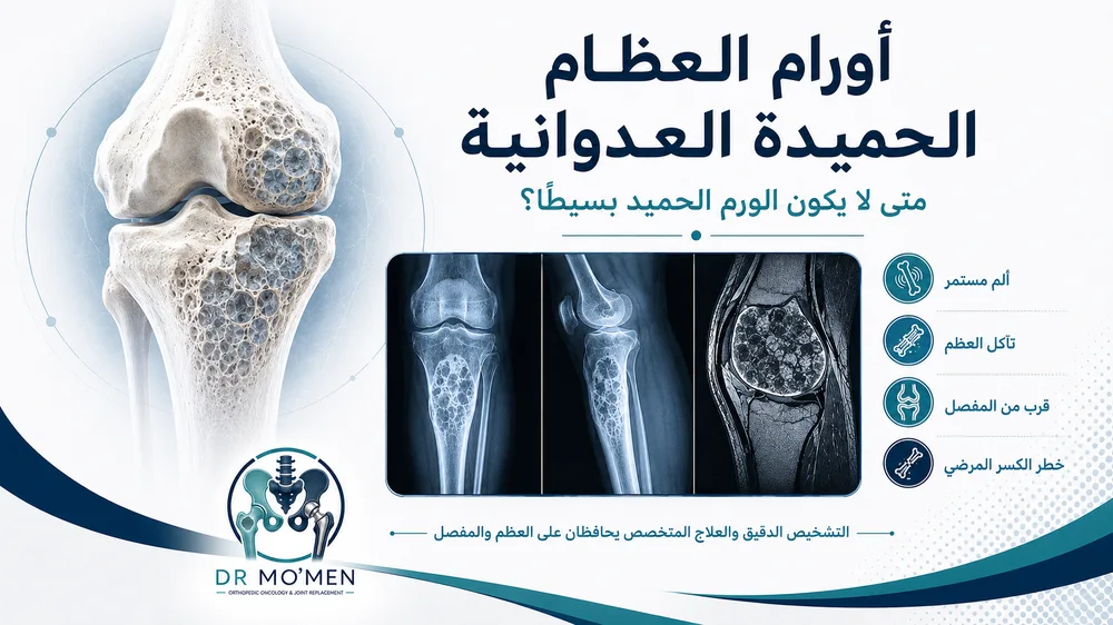 أورام العظام الحميدة العدوانية: متى لا يكون الورم الحميد بسيطًا؟