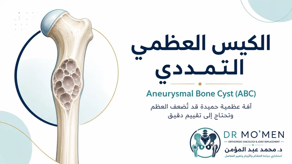 الكيس العظمي التمددي ABC: متى يكون كيس العظم أكثر نشاطًا ويحتاج إلى علاج دقيق؟