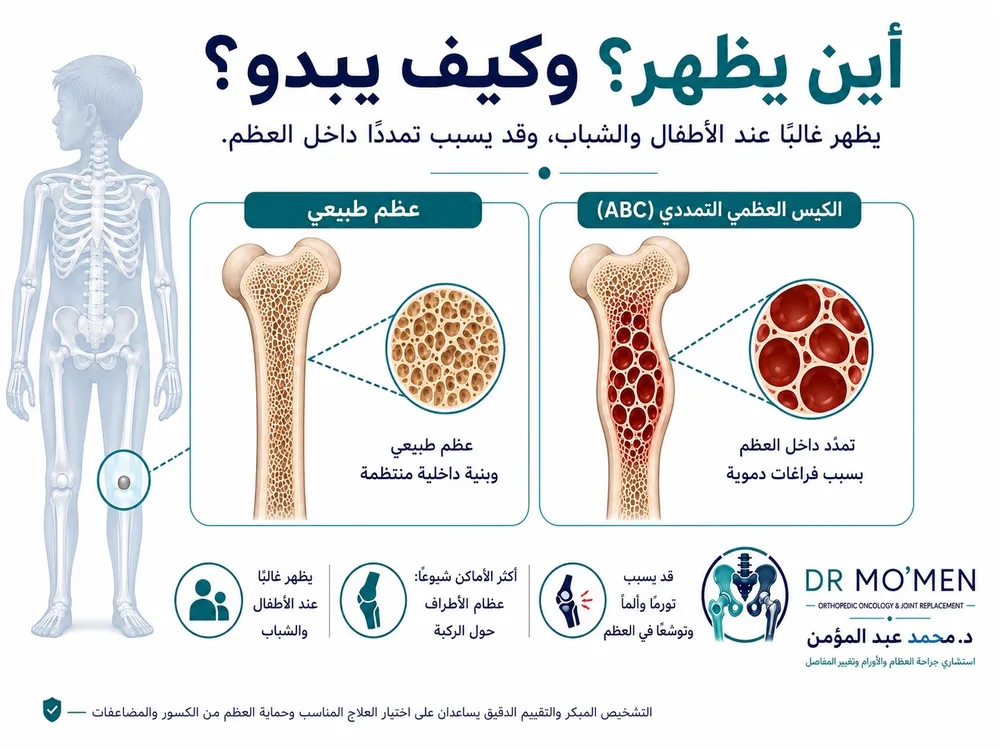 أماكن ظهور الكيس العظمي التمددي حول العظام الطويلة والحوض والعمود الفقري أماكن ظهور الكيس العظمي التمددي حول العظام الطويلة والحوض والعمود الفقري