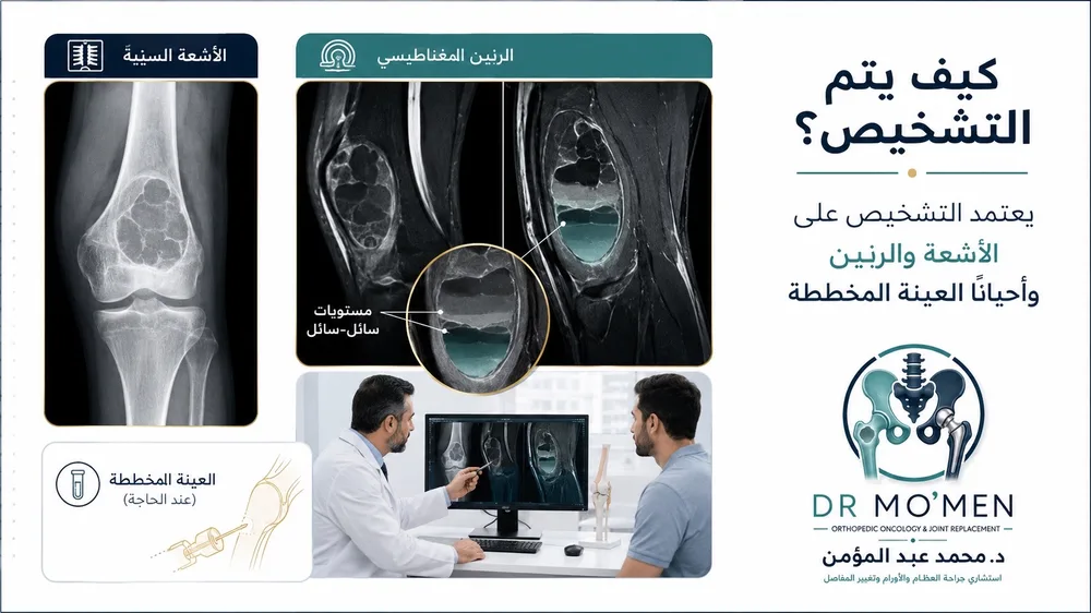 تشخيص الكيس العظمي التمددي بالرنين والأشعة لتقييم التمدد والتجاويف تشخيص الكيس العظمي التمددي بالرنين والأشعة لتقييم التمدد والتجاويف