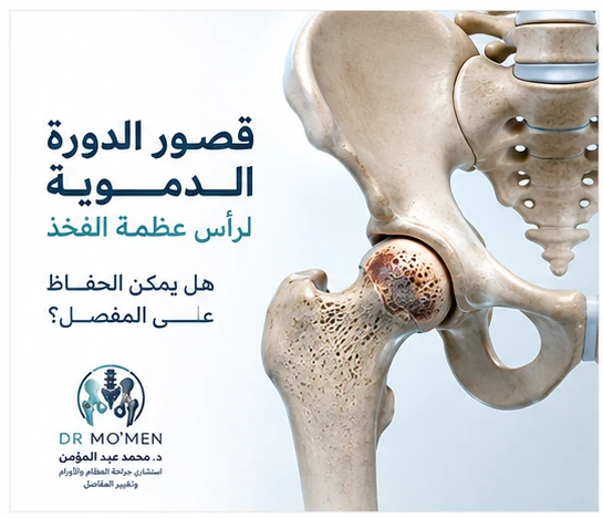 رسم طبي ثلاثي الأبعاد يوضح قصور الدورة الدموية ونخر رأس عظمة الفخذ
