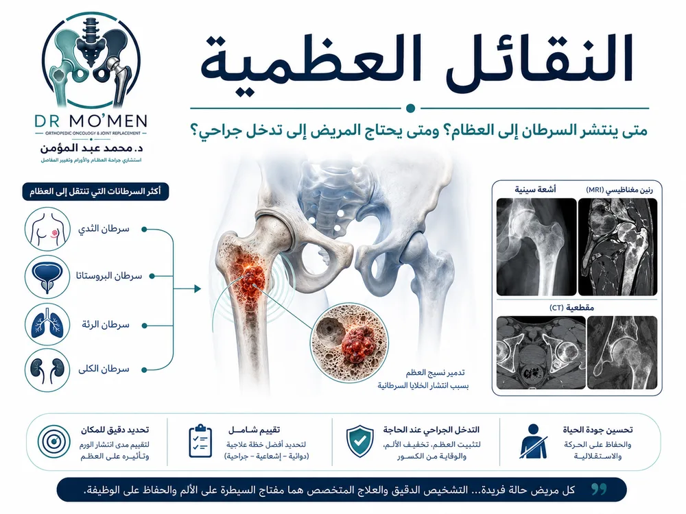 النقائل العظمية: متى ينتشر السرطان إلى العظام؟ ومتى يحتاج المريض إلى تدخل جراحي؟
