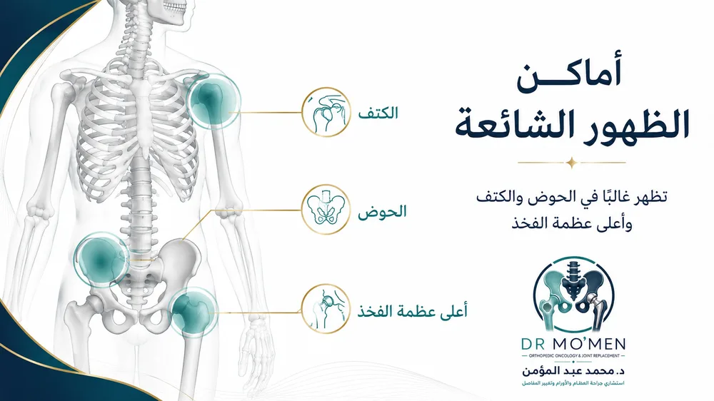 أماكن ظهور الساركوما الغضروفية مثل الحوض والكتف وأعلى الفخذ