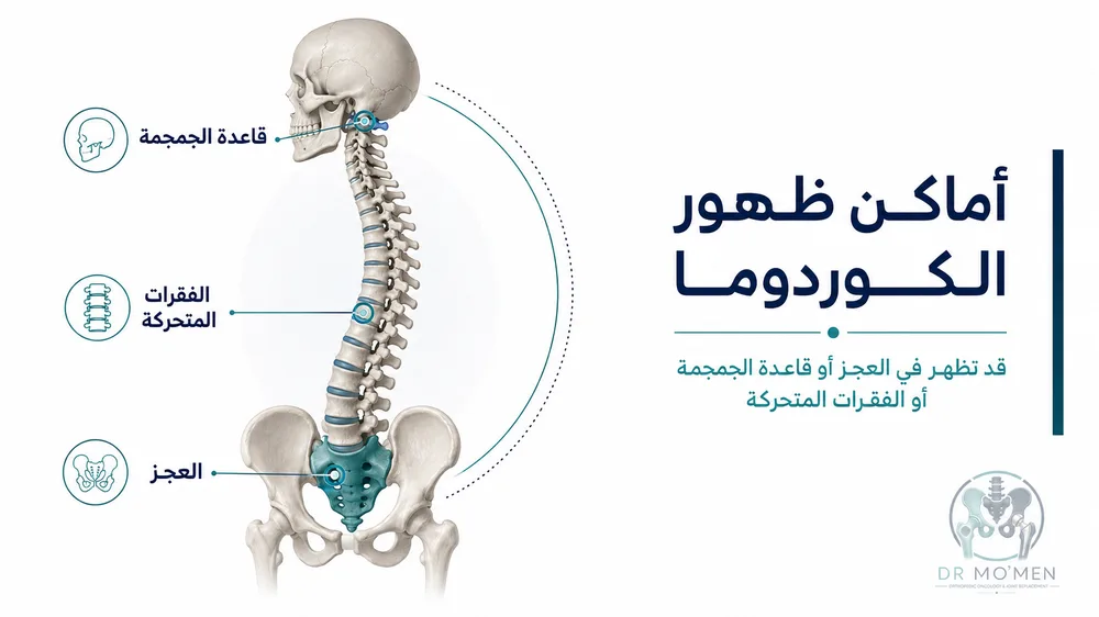 ألم أسفل الظهر أو الحوض مع كتلة في العجز قد يشير إلى كوردوما