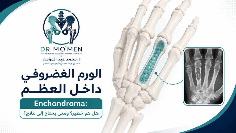 الورم الغضروفي داخل العظم Enchondroma: هل هو خطير؟ ومتى يحتاج إلى علاج؟