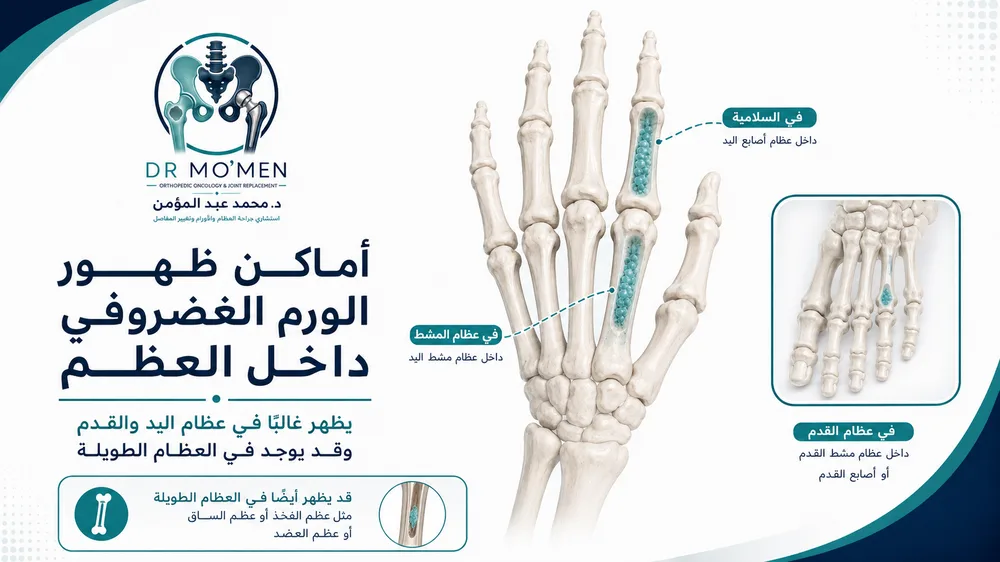 أماكن ظهور Enchondroma في أصابع اليد وعظام المشط والعظام الطويلة أماكن ظهور Enchondroma في أصابع اليد وعظام المشط والعظام الطويلة