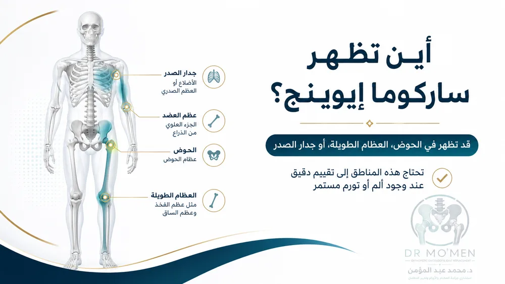 أماكن ظهور ساركوما إيوينج في الحوض والعظام الطويلة وجدار الصدر أماكن ظهور ساركوما إيوينج في الحوض والعظام الطويلة وجدار الصدر