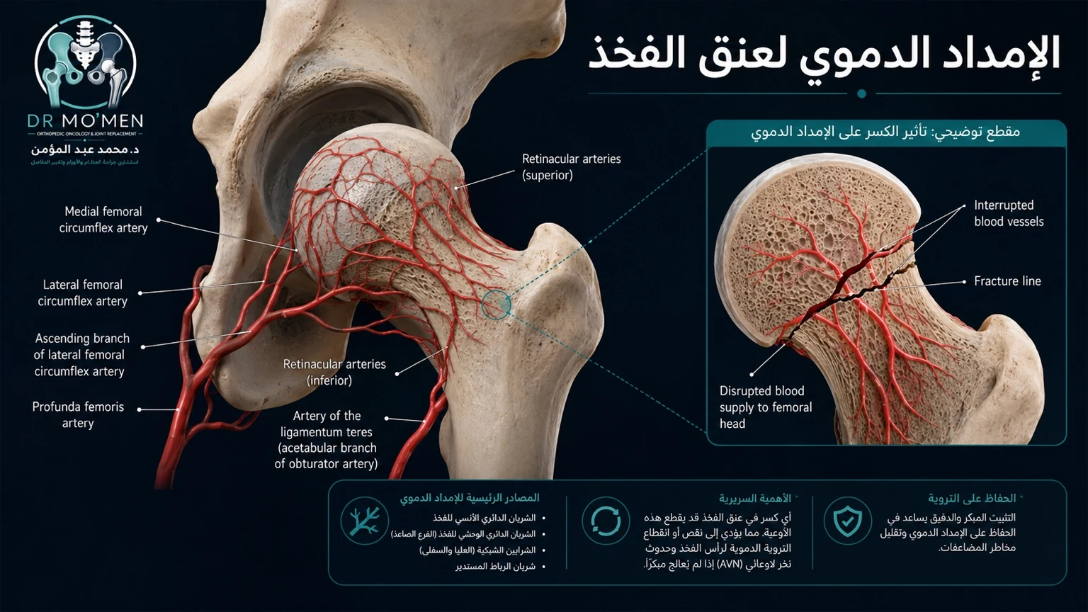 رسم طبي توضيحي يوضح شبكة الأوعية الدموية المغذية لرأس عظمة الفخذ وكيف يقطعها الكسر