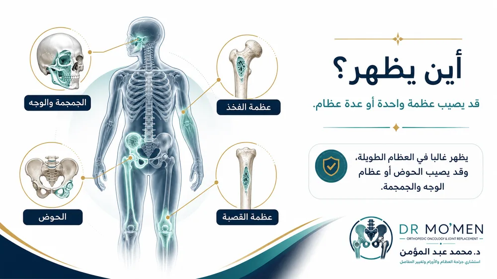 أماكن ظهور خلل التنسج الليفي مثل الفخذ والقصبة والحوض والجمجمة أماكن ظهور خلل التنسج الليفي مثل الفخذ والقصبة والحوض والجمجمة