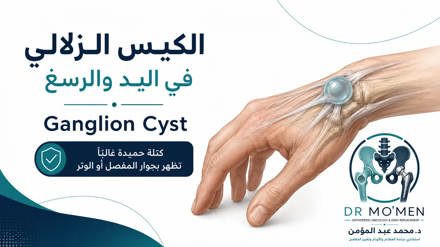 الكيس الزلالي في اليد والرسغ: هل هو خطير؟ ومتى يحتاج إلى علاج؟