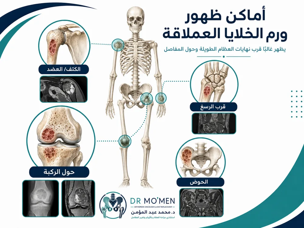 أماكن شائعة لورم الخلايا العملاقة حول الركبة والرسغ والكاحل