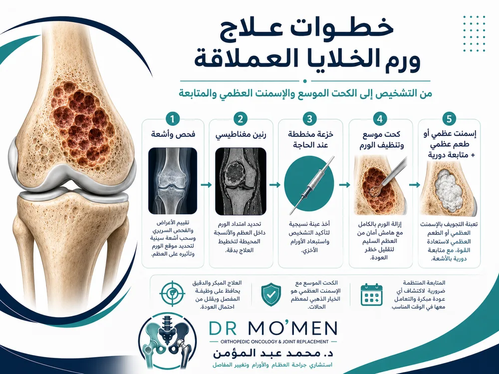 علاج ورم الخلايا العملاقة بالكحت الموسع أو الاستئصال والمتابعة