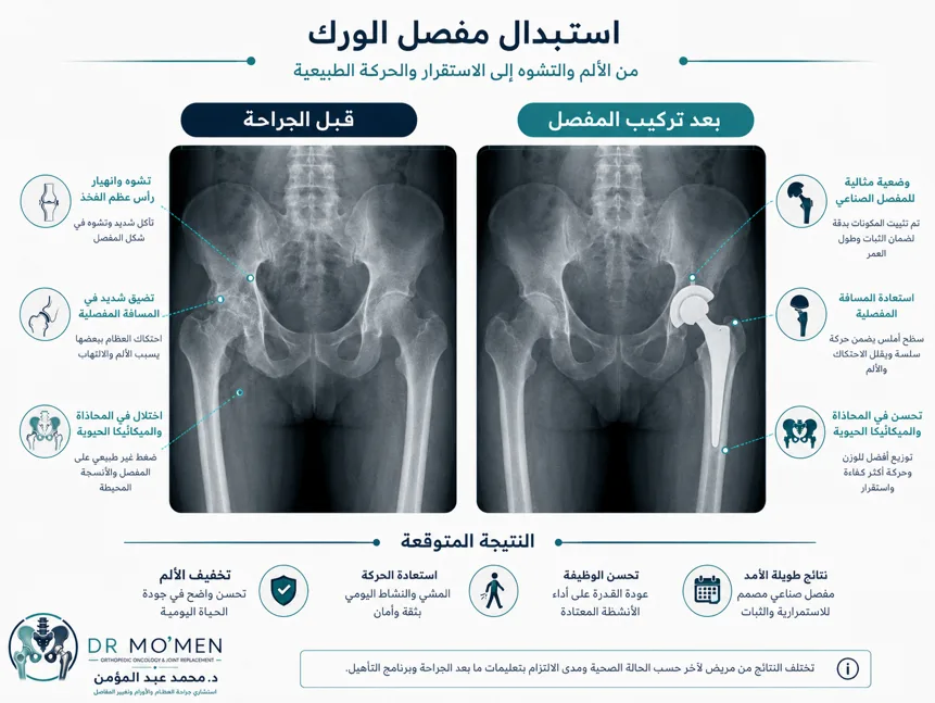 تقييم مفصل الفخذ بالأشعة والفحص قبل اختيار نوع المفصل الصناعي تقييم مفصل الفخذ بالأشعة والفحص قبل اختيار نوع المفصل الصناعي