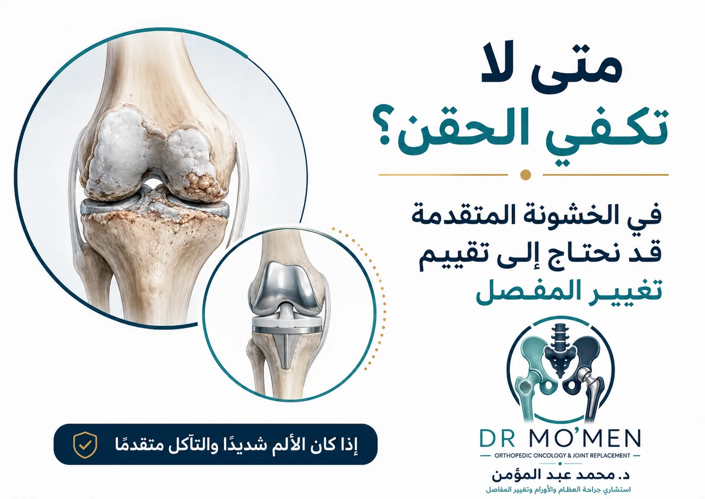 متى لا تكفي حقن الركبة ونحتاج تقييم تغيير المفصل متى لا تكفي حقن الركبة ونحتاج تقييم تغيير المفصل
