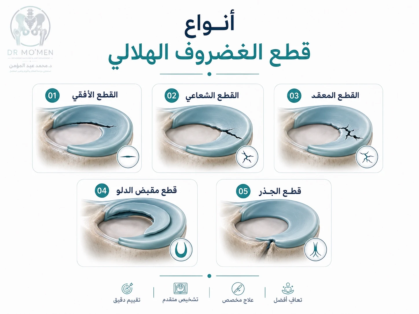 إنفوجرافيك يوضح أنواع قطع الغضروف الهلالي في رنين الركبة