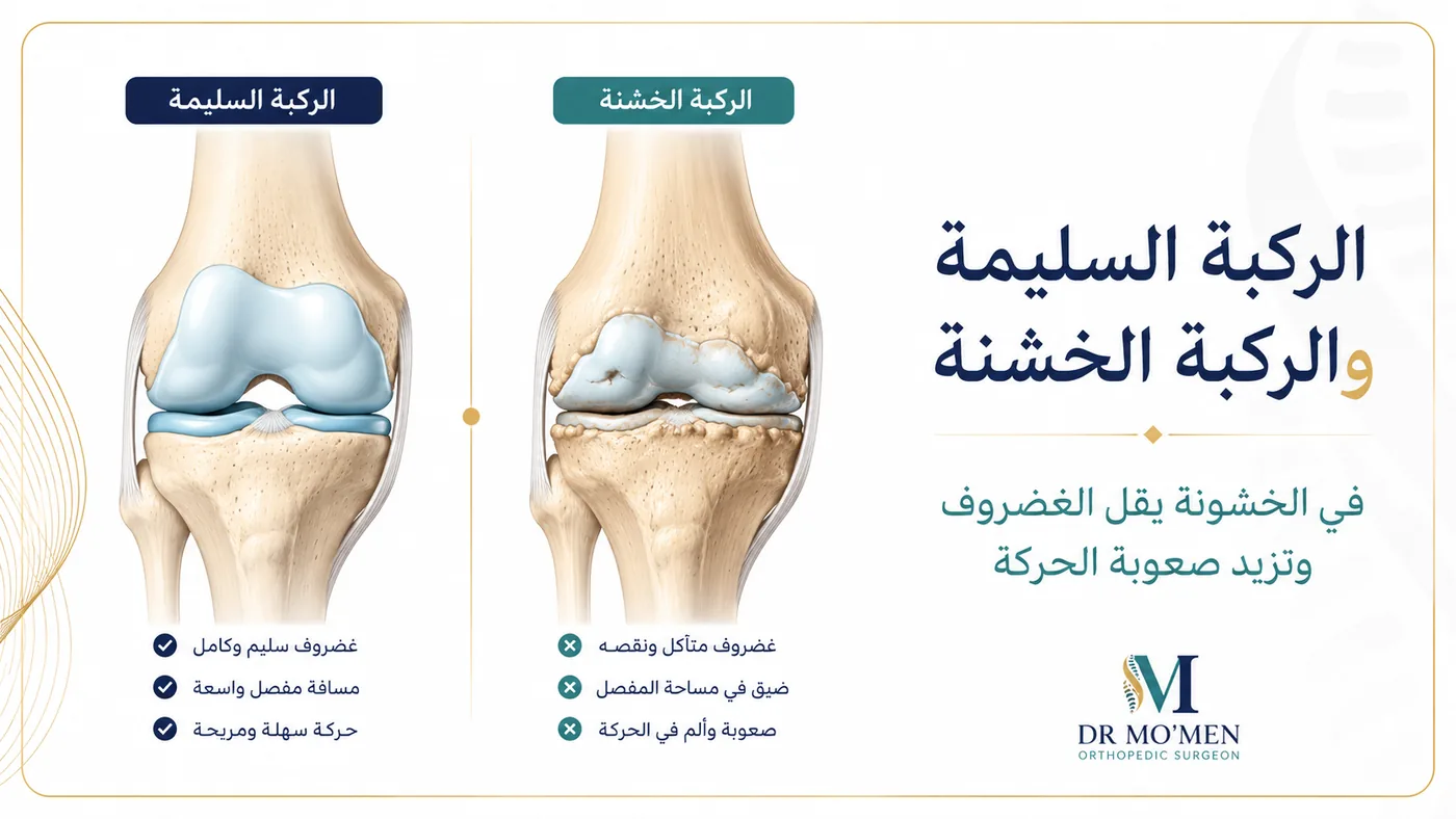 الفرق بين الركبة السليمة وخشونة الركبة وتآكل الغضروف الفرق بين الركبة السليمة وخشونة الركبة وتآكل الغضروف