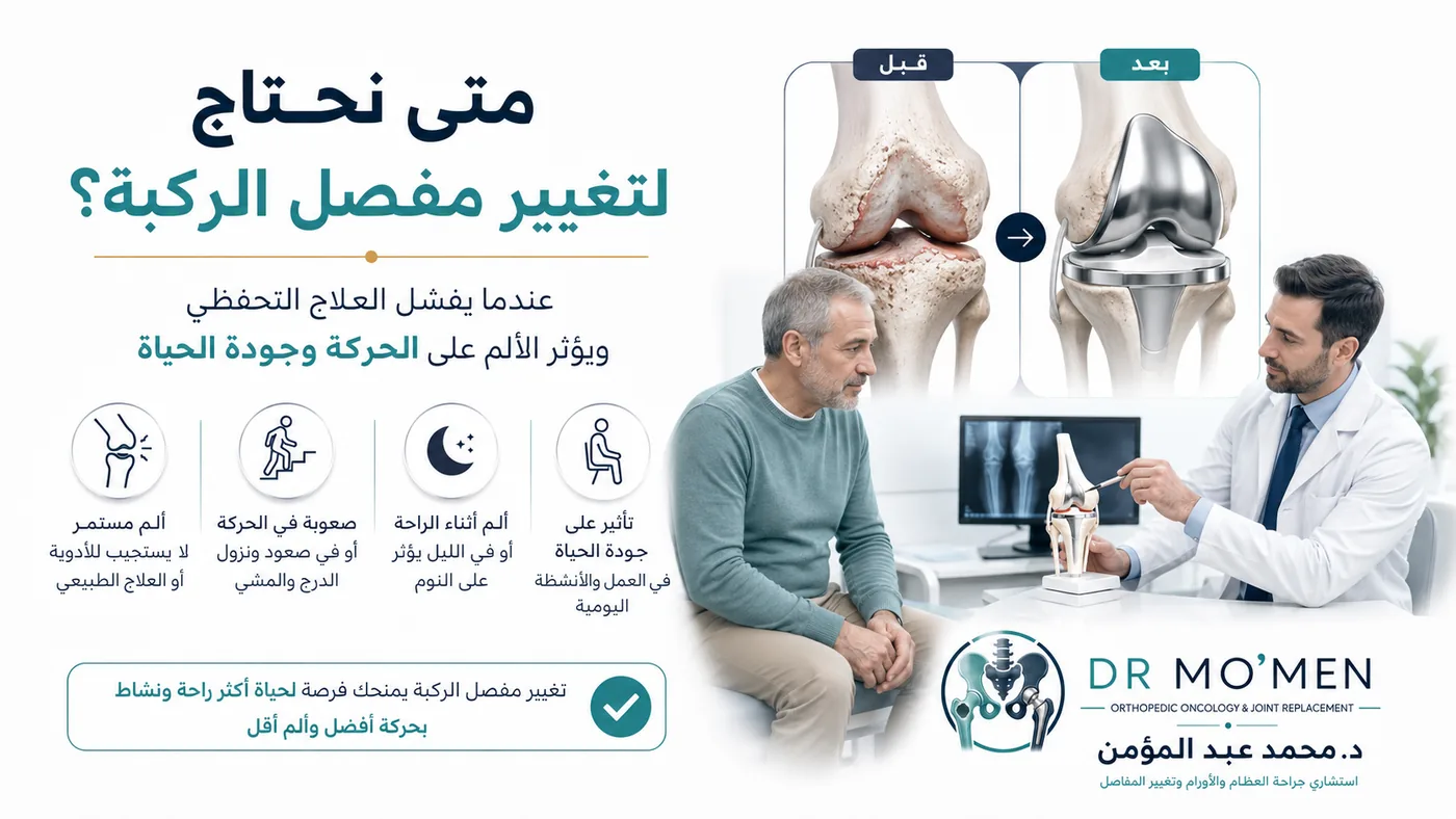 متى يحتاج مريض خشونة الركبة إلى تغيير مفصل الركبة في الخشونة المتقدمة متى يحتاج مريض خشونة الركبة إلى تغيير مفصل الركبة في الخشونة المتقدمة