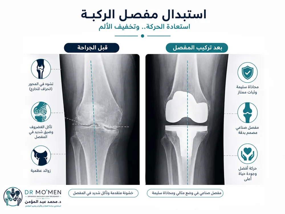 تقييم خشونة الركبة بالأشعة والفحص قبل قرار تغيير المفصل تقييم خشونة الركبة بالأشعة والفحص قبل قرار تغيير المفصل