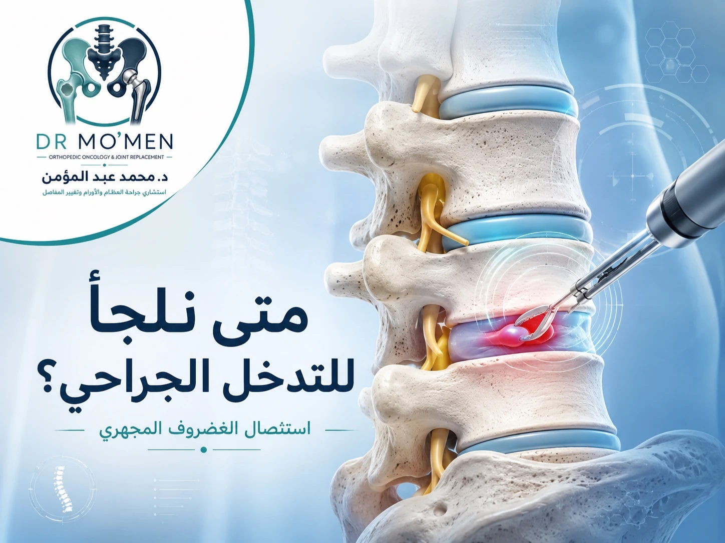 مفهوم استئصال الغضروف المجهري الدقيق