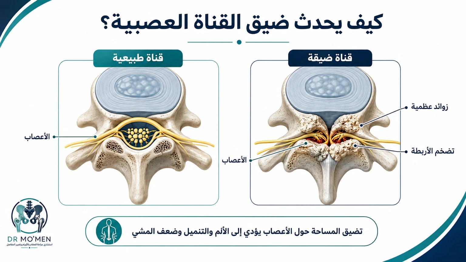 إنفوجرافيك يوضح الفرق بين القناة العصبية السليمة والقناة الضيقة