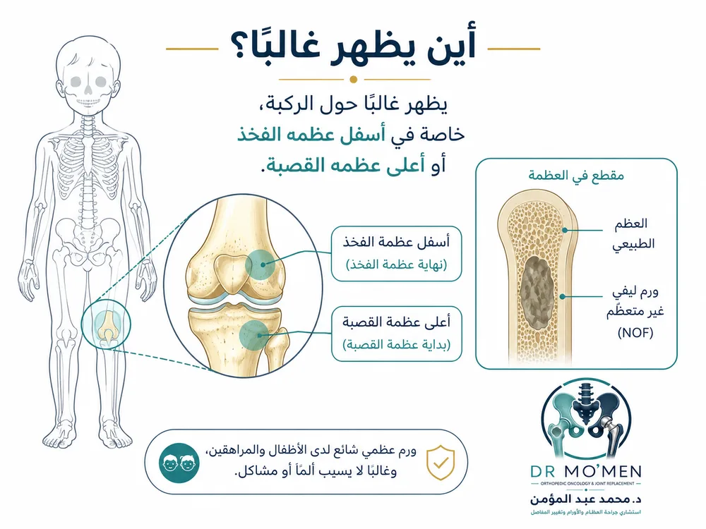 أماكن ظهور NOF حول الركبة في عظمة الفخذ أو القصبة أماكن ظهور NOF حول الركبة في عظمة الفخذ أو القصبة