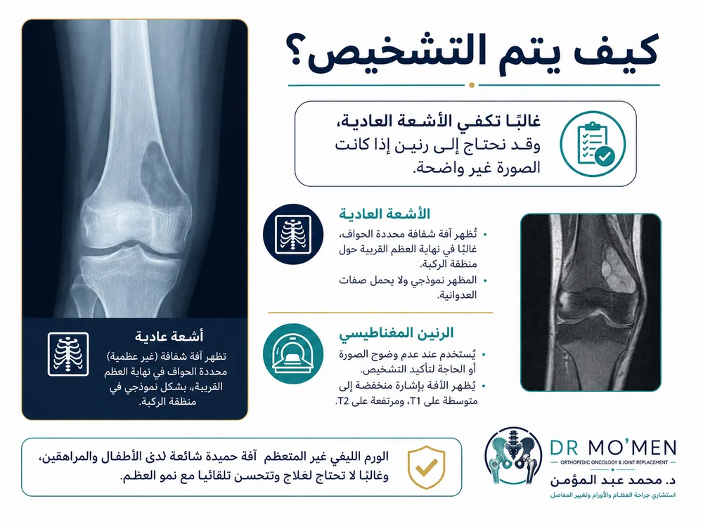 تشخيص الورم الليفي غير المتعظم بالأشعة العادية ومتى نحتاج الرنين تشخيص الورم الليفي غير المتعظم بالأشعة العادية ومتى نحتاج الرنين