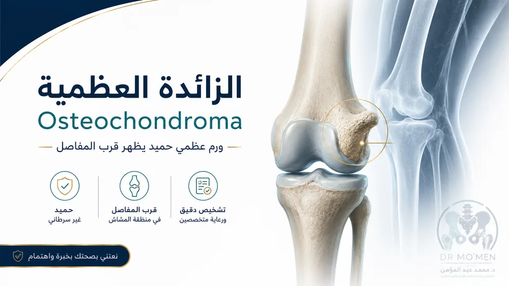 الزائدة العظمية Osteochondroma: متى تكون بسيطة؟ ومتى تشير إلى متلازمة وراثية؟
