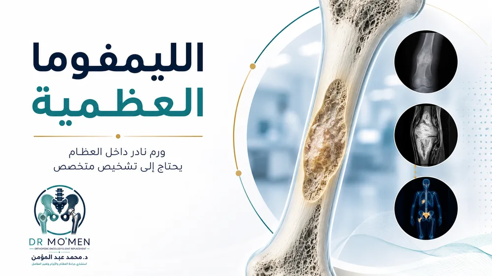 الليمفوما العظمية: ورم نادر في العظام قد يتشابه مع الالتهاب أو الأورام الأخرى