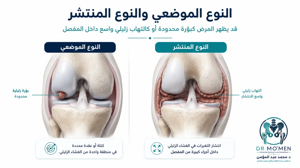 الرنين المغناطيسي لتقييم انتشار PVNS داخل مفصل الركبة أو الكاحل الرنين المغناطيسي لتقييم انتشار PVNS داخل مفصل الركبة أو الكاحل
