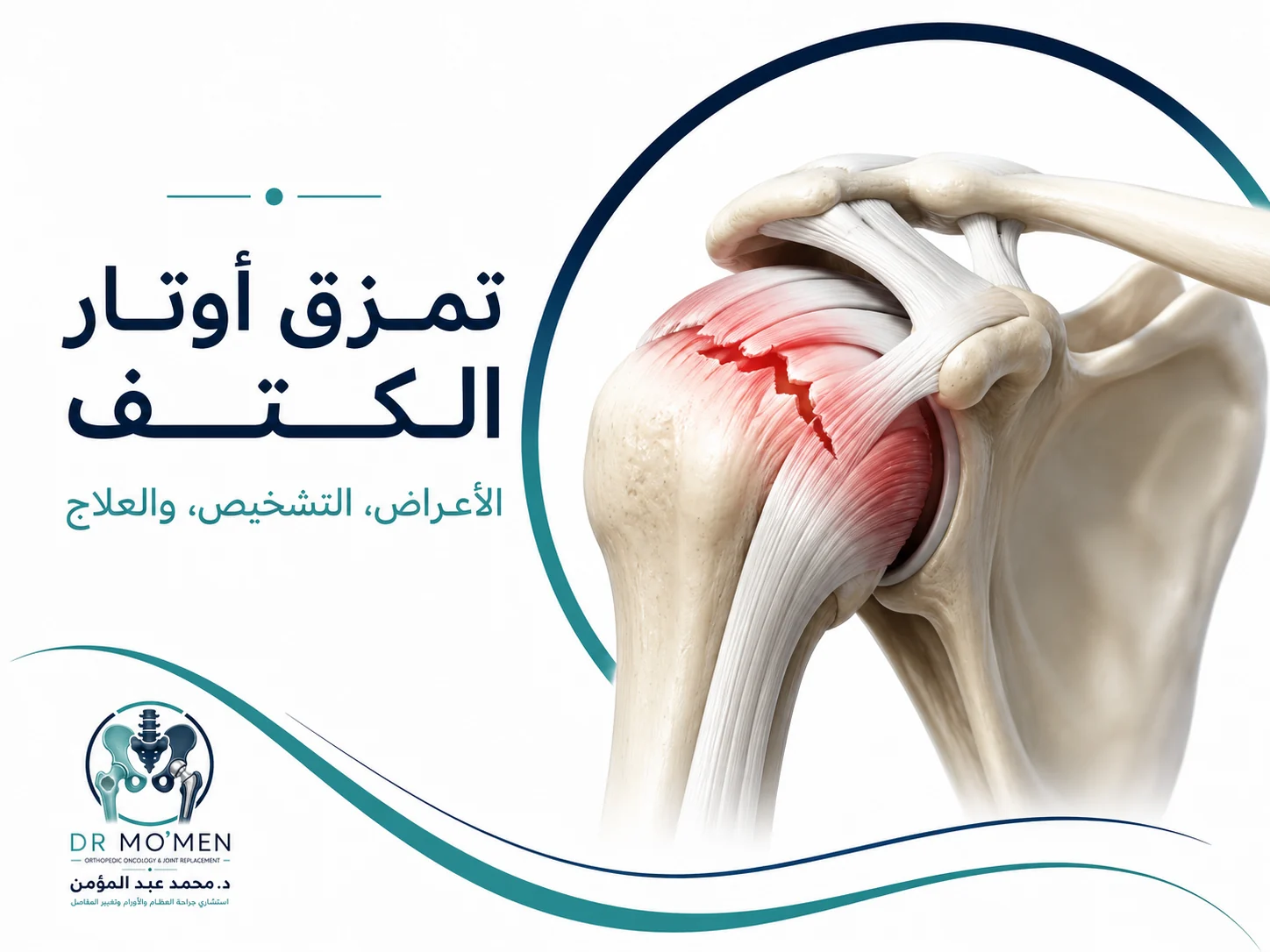 رسم طبي ثلاثي الأبعاد يوضح تمزق أوتار الكتف ومكان القطع في وتر الكفة المدورة