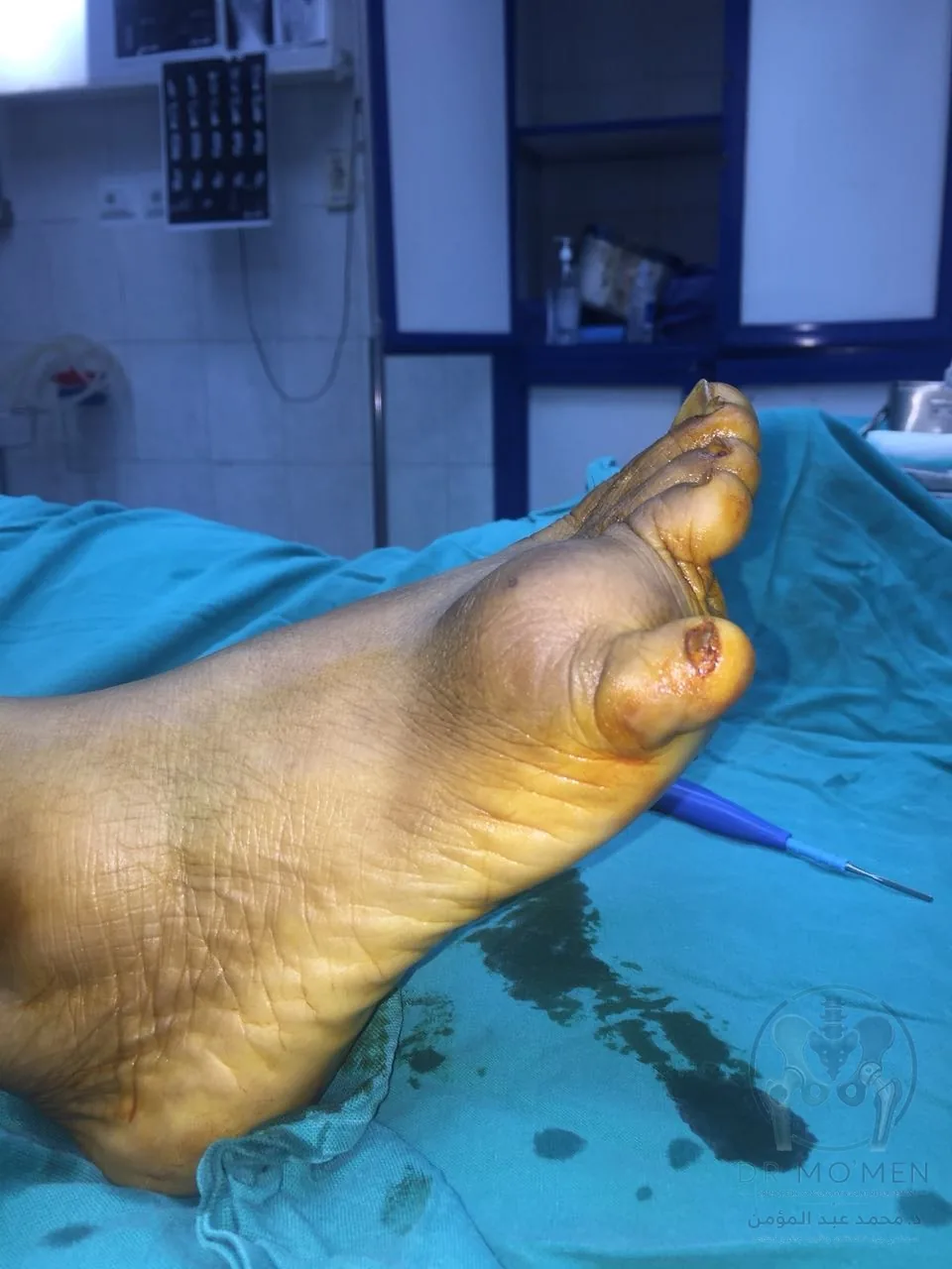 صورة جانبية قبل الجراحة: بروز الكتلة وعلاقتها بالجلد والأنسجة الرخوة المجاورة.