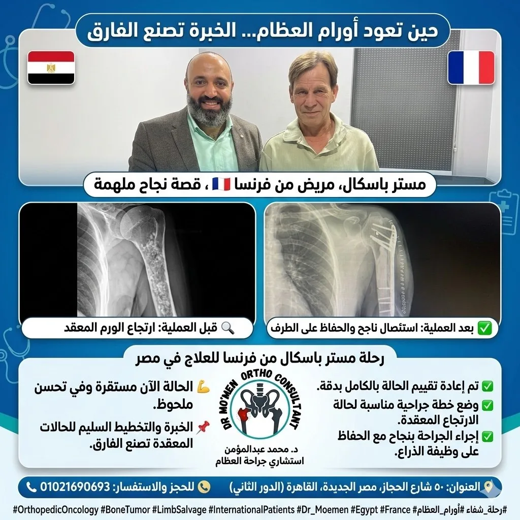 حالة إنقاذ طرف في ورم عظم العضد