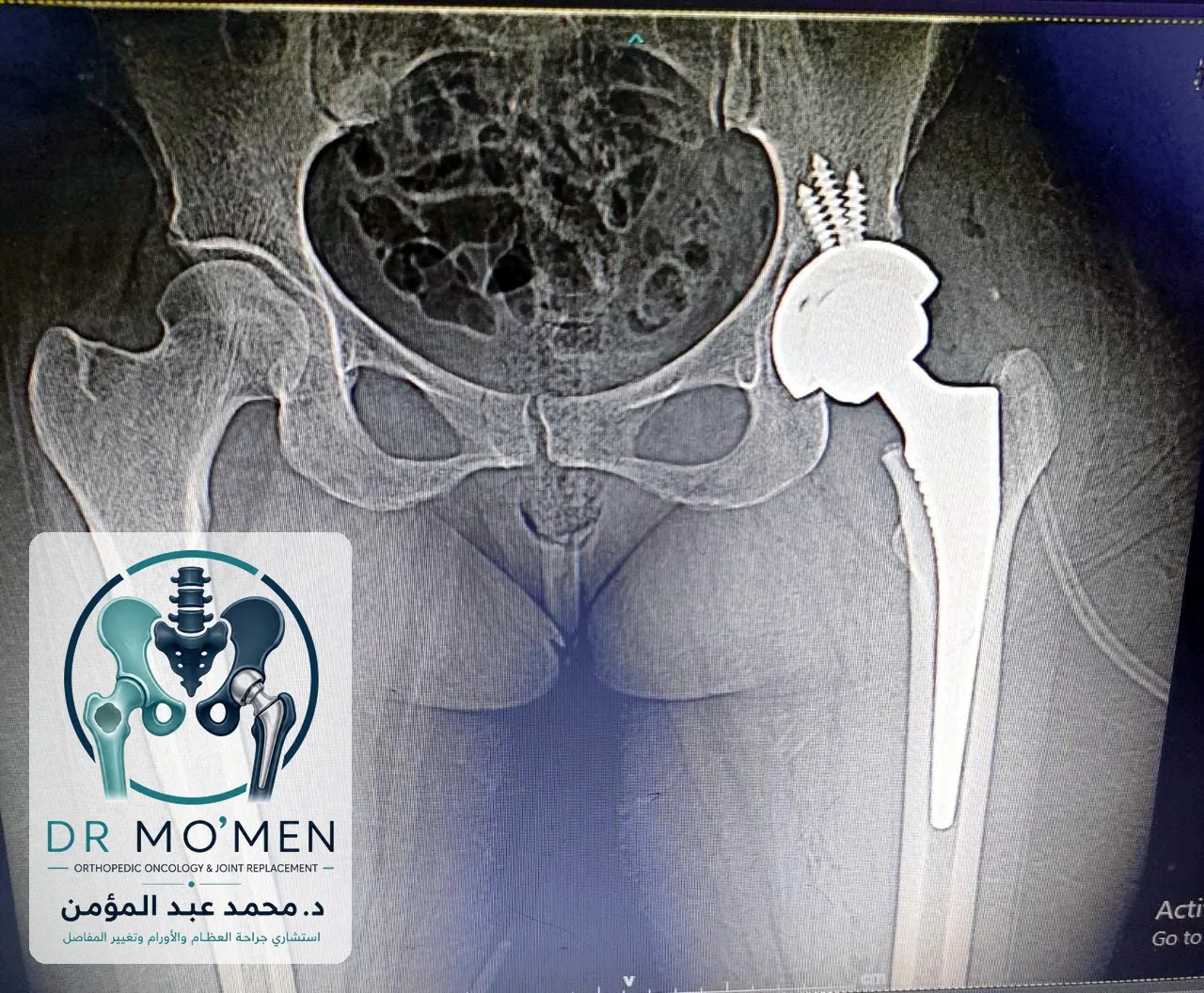 أشعة حوض أمامية بعد تغيير مفصل الفخذ الأيسر الكامل غير الأسمنتي